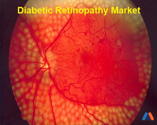 Diabetic Retinopathy Market.JPG